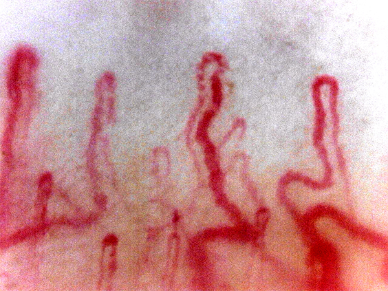 Nailfold (fingernail) capillaries (Massive zoom)