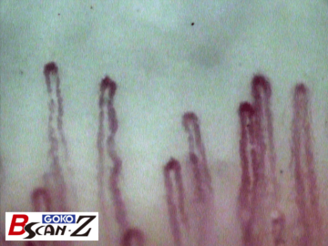 Sample picture of nailfold capillaries which was taken by the capillaroscope GOKO Bscan-Z