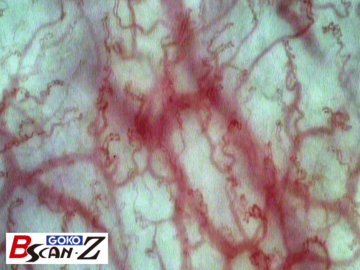 Sample picture of labial microvascular capillaries in lips which was taken by the capillaroscope GOKO Bscan-Z