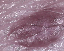 Pimples (i)