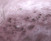 Pimples (ii)*