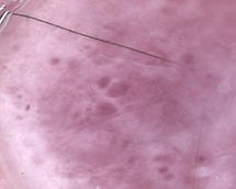 Warts (ii)*