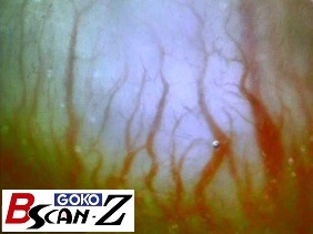 Lower gingiva capillaries which are magnified up to 150 times which was taken by the capillaroscope GOKO Bscan-Z