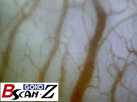 Lower gingiva capillaries which are magnified up to 560 times which was taken by the capillaroscope GOKO Bscan-Z