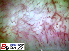 Capillaries in upper gum which are magnified up to 150 times which was taken by the capillaroscope GOKO Bscan-Z
