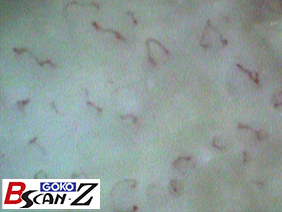 Lower gingiva capillaries which are magnified up to 560 times which was taken by the capillaroscope GOKO Bscan-Z