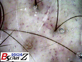 Hair roots which are magnified up to 560 times which was taken by the capillaroscope GOKO Bscan-Z