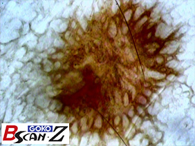 全身毛細血管スコープGOKO Bscan-Zで撮影した約150倍のほくろと毛細血管画像