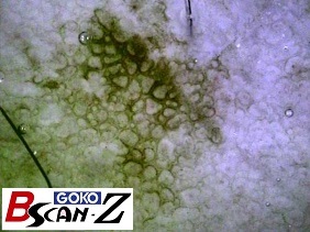 全身毛細血管スコープGOKO Bscan-Zで撮影した約150倍のほくろと毛細血管画像