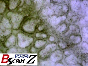 全身毛細血管スコープGOKO Bscan-Zで撮影した約560倍のほくろと毛細血管画像