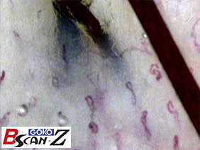 全身毛細血管スコープGOKO Bscan-Zで撮影した約560倍の頭皮毛細血管画像