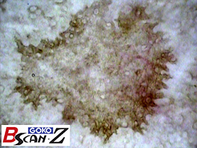 Skin blotch which are magnified up to 150 times which was taken by the capillaroscope GOKO Bscan-Z