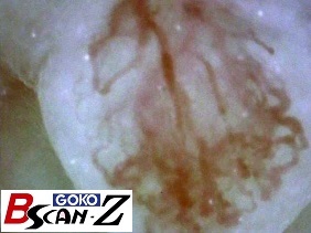 全身毛細血管スコープGOKO Bscan-Zで撮影した約560倍の舌乳頭の毛細血管画像