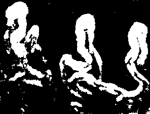 灌流領域マップ：施術後