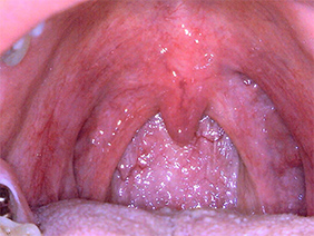 Pharynx, tonsils