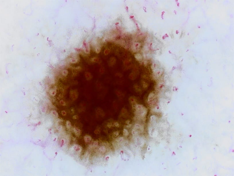 微細なほくろ（直径約1mm）175倍 従来バージョン