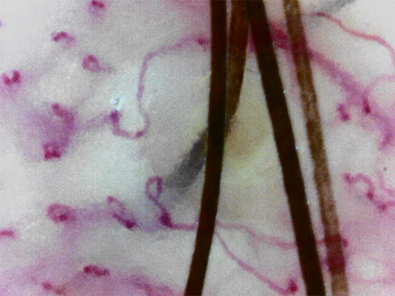 Scalp capillaries (620X)