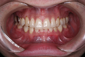 Intraoral mode