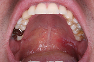 Intraoral mode