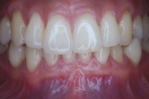 Intraoral mode