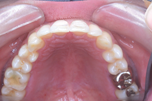 Intraoral mode