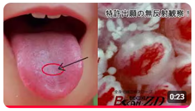 舌の毛細血管