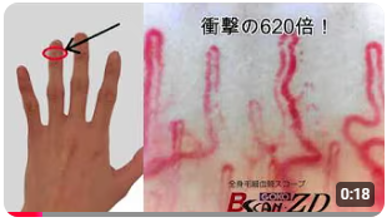 爪郭部の毛細血管