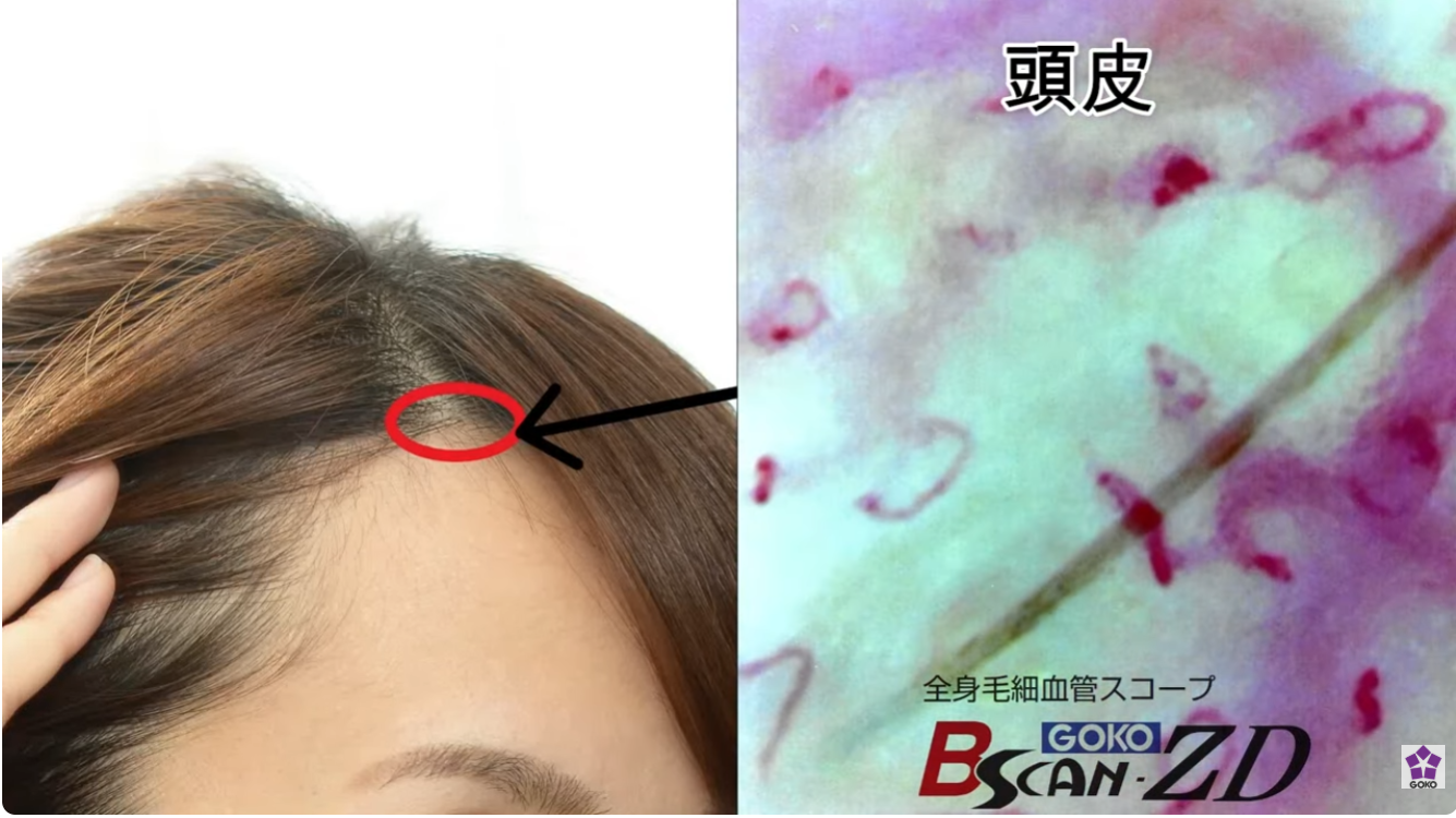 頭皮の毛細血管