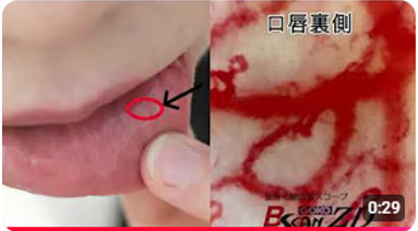 唇の毛細血管