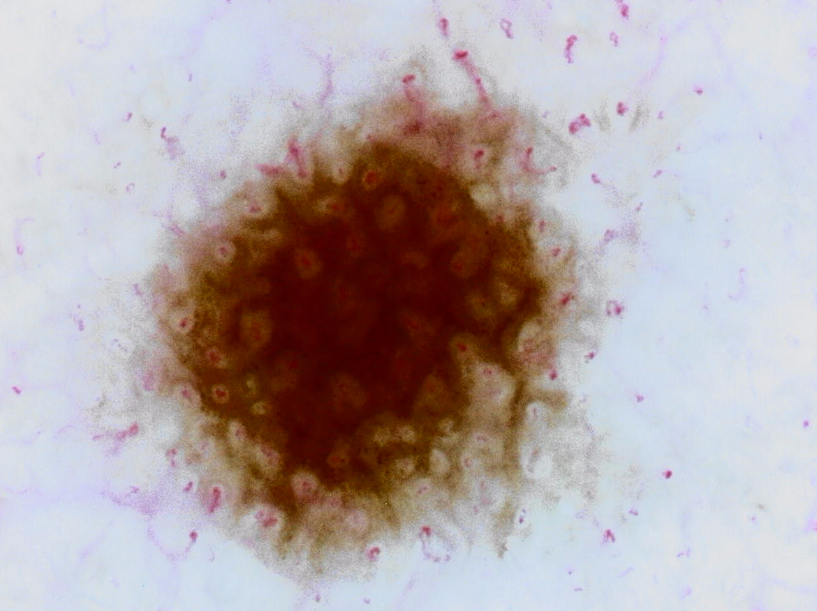 微細なほくろ（直径約1mm）175倍 従来バージョン