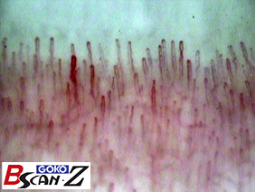 Nailfold capillaries (145×)