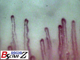 Nailfold capillaries (590×)