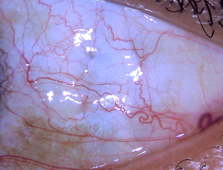 Eyeball