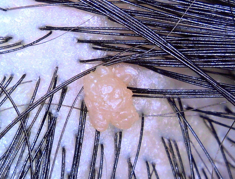Wart on the scalp