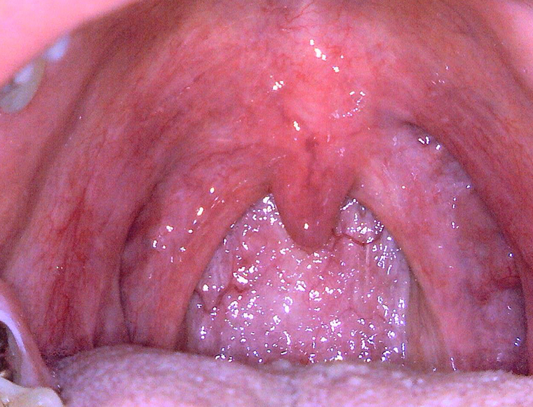 Pharynx, tonsils