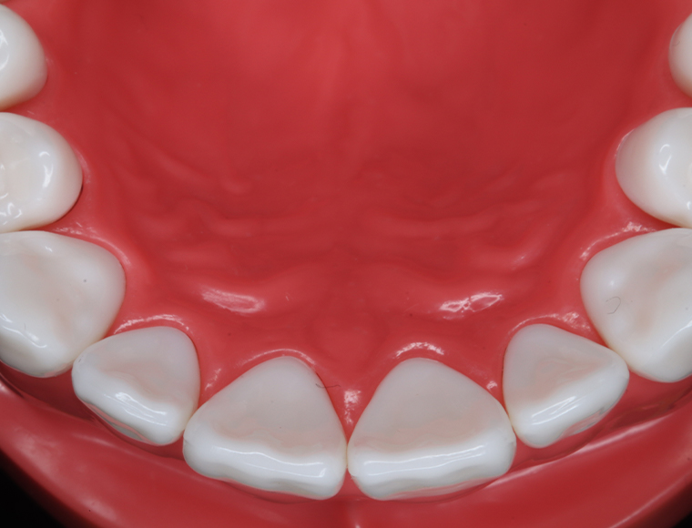 Maxillary occlusal view