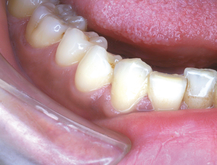 Intraoral mode